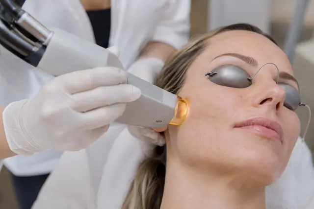 A laser treatment in progress, the client wearing protective eye shields